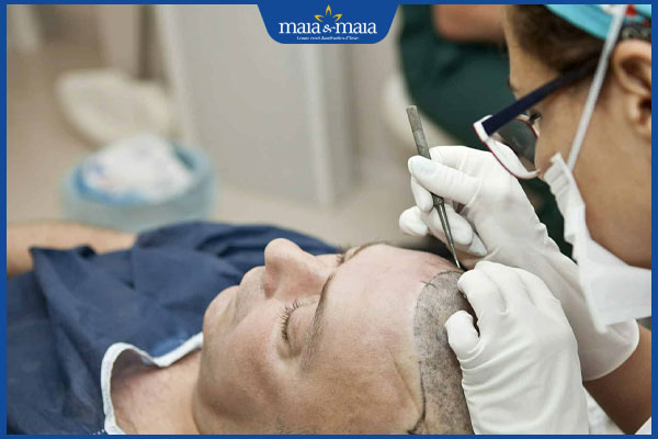 phương pháp cấy tóc sinh học