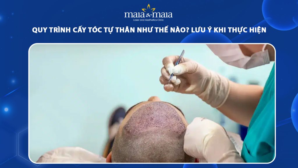 quy trình cấy tóc tự thân