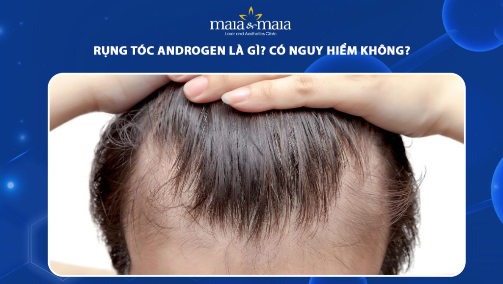 rụng tóc androgen