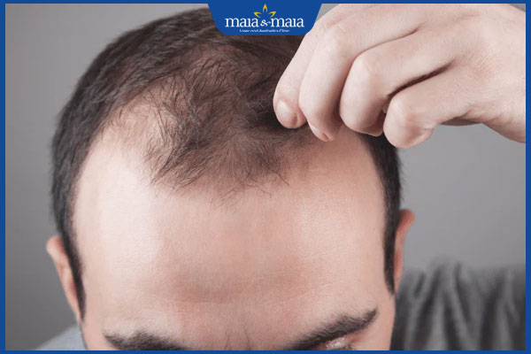 Rụng tóc do nội tiết có dấu hiệu gì? Chẩn đoán và điều trị 2 rụng tóc androgen ở nam