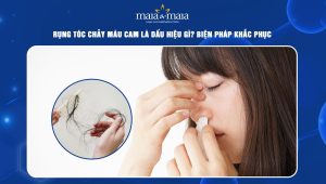 rụng tóc chảy máu cam