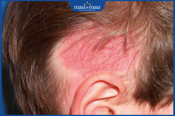 Rụng tóc sau sinh bao lâu thì hết? Cách làm tóc mọc nhanh 3 rụng tóc đỏ da đầu