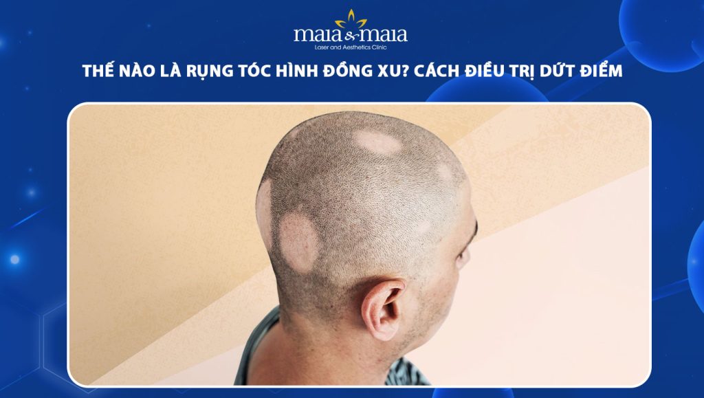 rụng tóc hình đồng xu