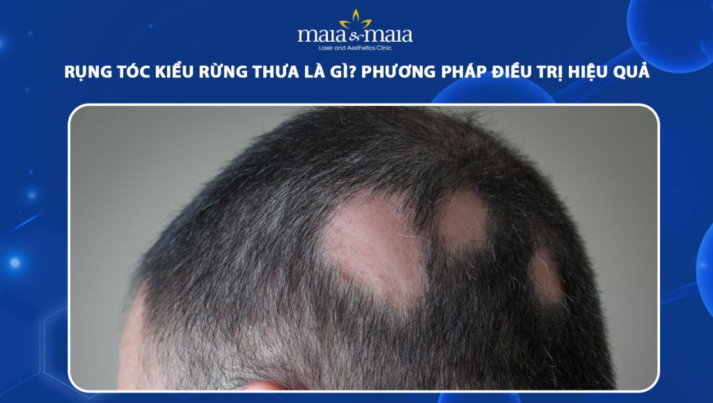Rụng tóc kiểu rừng thưa là gì? Phương pháp điều trị hiệu quả 1 rụng tóc kiểu rừng thưa