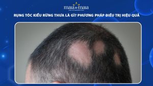 rụng tóc kiểu rừng thưa