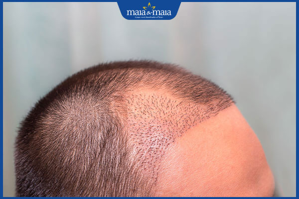 rụng tóc sau cấy