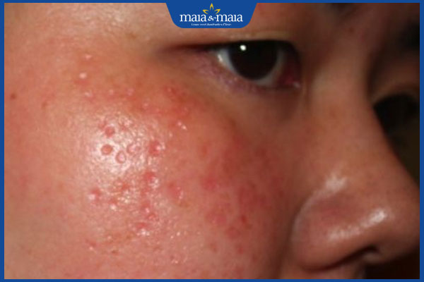 Chấm tàn nhang có tái lại không? Cách xóa tàn nhang dứt điểm 4 sẹo lõm sau khi chấm tàn nhang