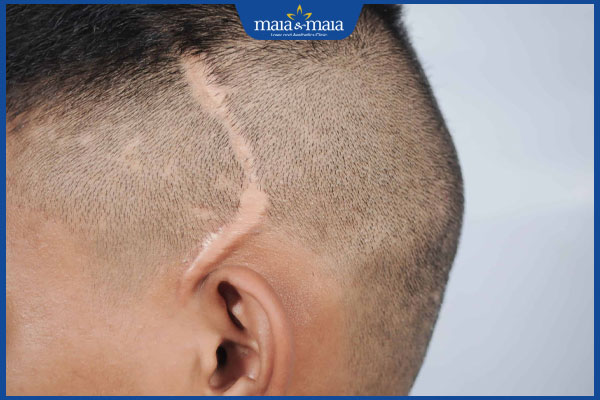 sẹo trên đầu