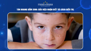 tàn nhang bẩm sinh