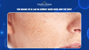 tàn nhang có bị lan ra không