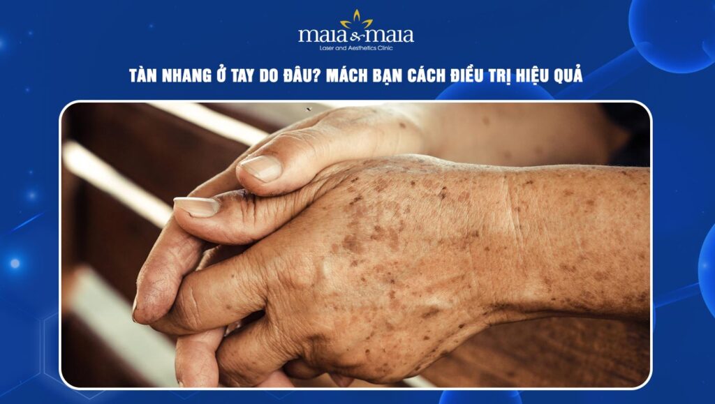 Tàn nhang ở tay do đâu? Mách bạn cách điều trị hiệu quả 1 tàn nhang ở tay