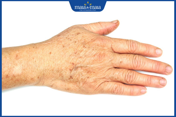 Tàn nhang ở tay do đâu? Mách bạn cách điều trị hiệu quả 2 tàn nhang trên tay