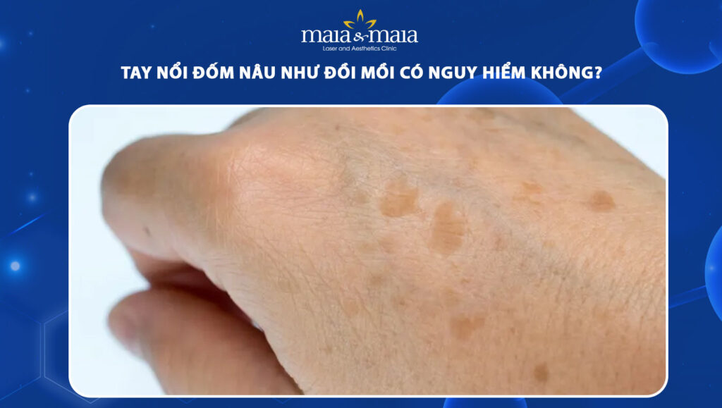 tay nổi đốm nâu như đồi mồi