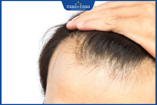 thăm khám hói trán