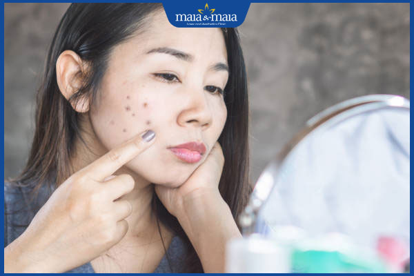 6 cách chăm sóc vết thâm sau khi đốt tàn nhang đơn giản 2 thâm sau khi bắn tàn nhang