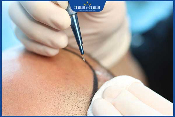 thiết bị cấy tóc