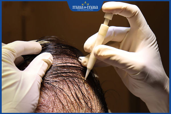 thực hiện cấy tóc DHI