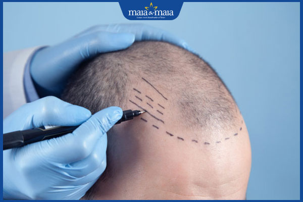 thực hiện cấy tóc HAT