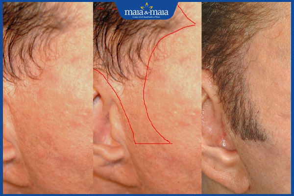 thực hiện cấy tóc mai