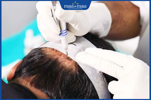 thực hiện cấy tóc nhân tạo