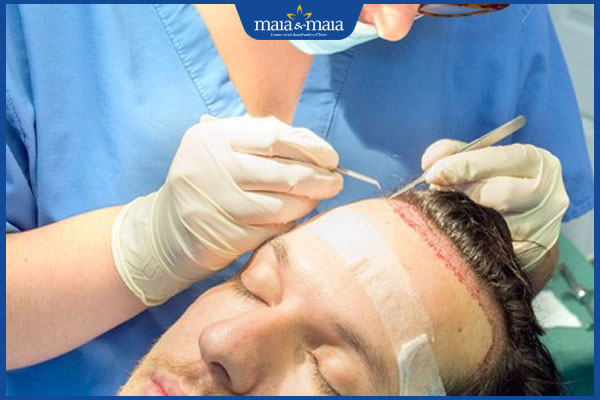 thực hiện cấy tóc tự thân