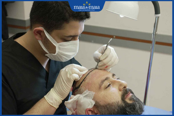 thực hiện cấy tóc