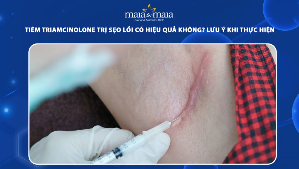 tiêm Triamcinolone trị sẹo lồi