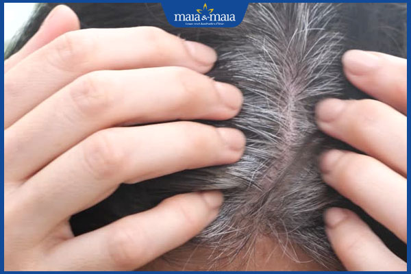 tình trạng tóc bạc sau sinh