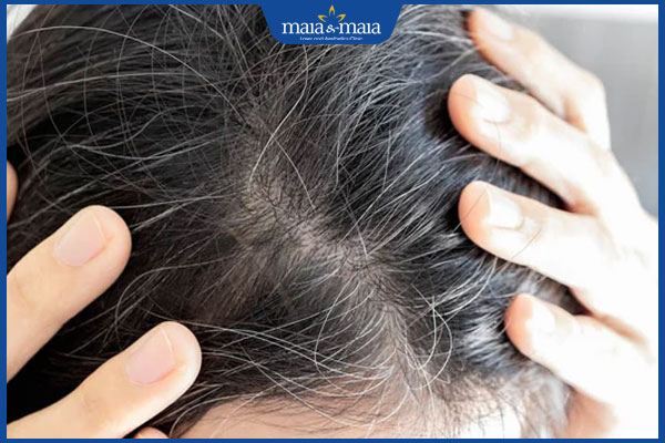 tình trạng tóc bạc sớm