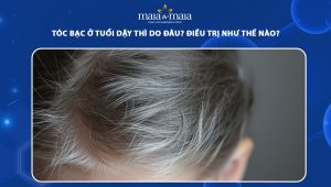 tóc bạc ở tuổi dậy thì