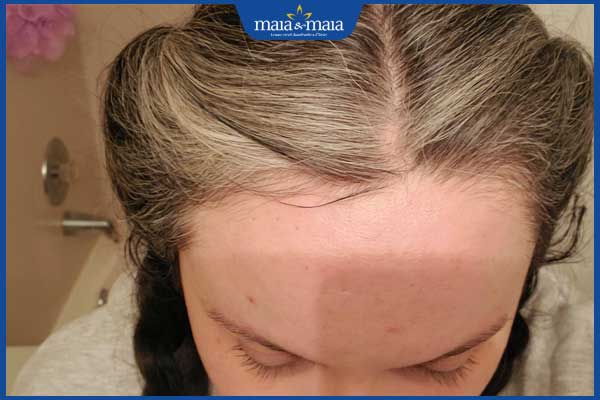 tóc bạc sớm ở trẻ