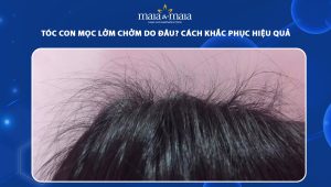 tóc con mọc lởm chởm