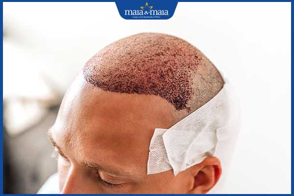 Cấy tóc bao lâu thì mọc lại? Cách chăm sóc để tóc nhanh mọc 2 tóc mọc lại sau cấy