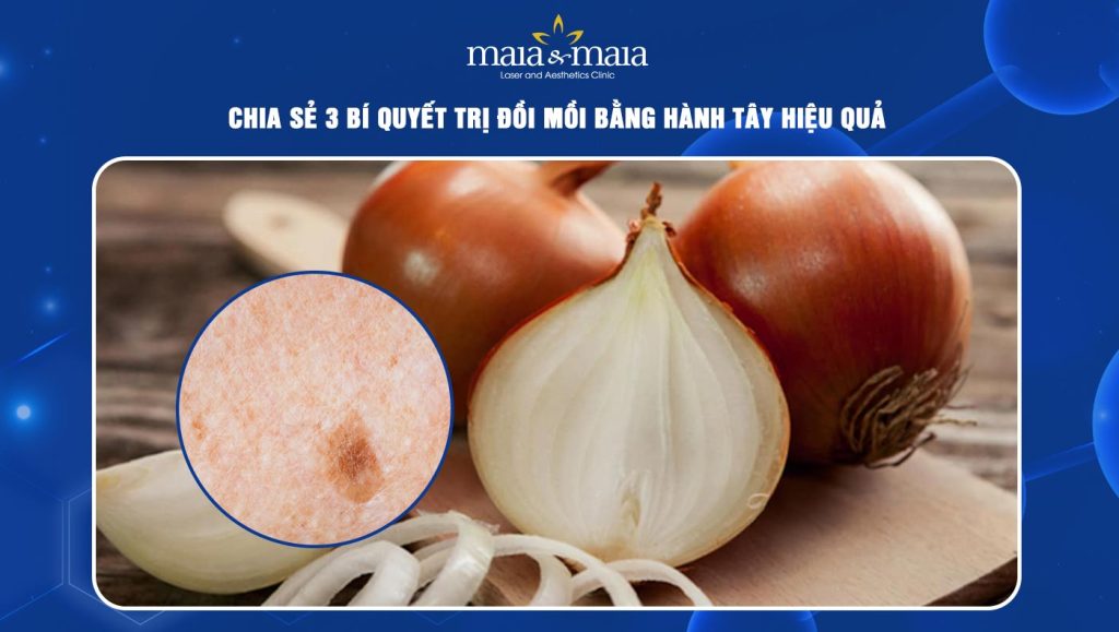 trị đồi mồi bằng hành tây