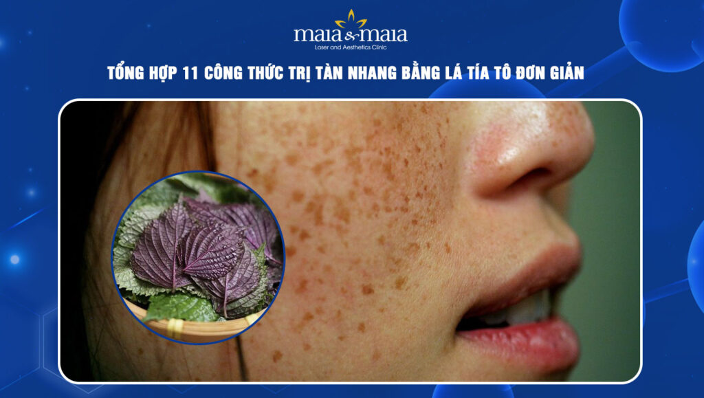 trị tàn nhang bằng lá tía tô