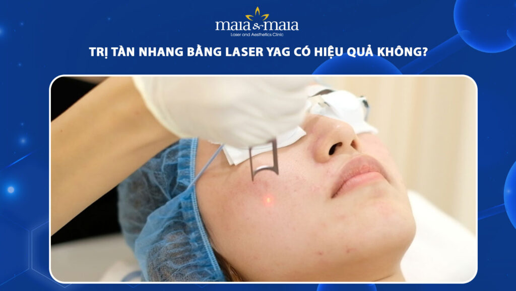 trị tàn nhang bằng laser yag