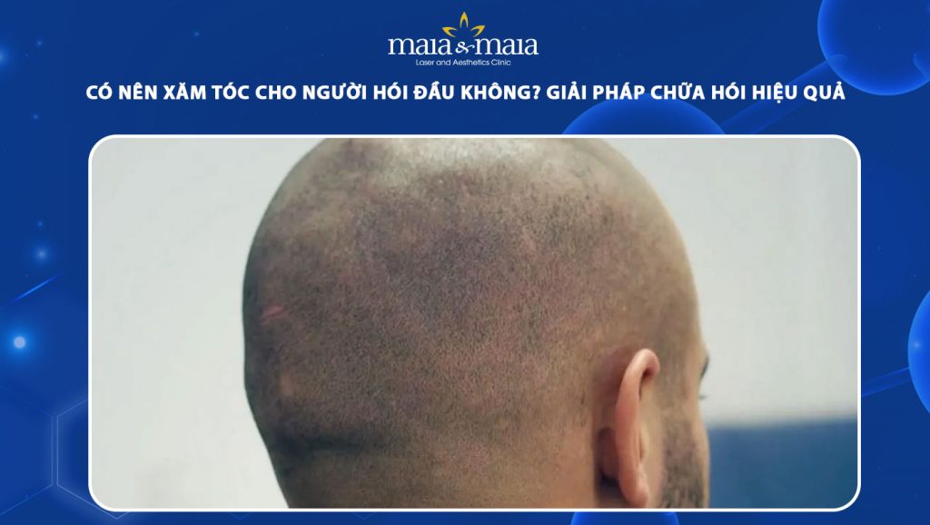 Ưu và nhược điểm khi thực hiện xăm tóc cho người hói đầu 1 xăm tóc cho người hói đầu