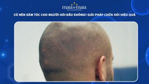 xăm tóc cho người hói đầu