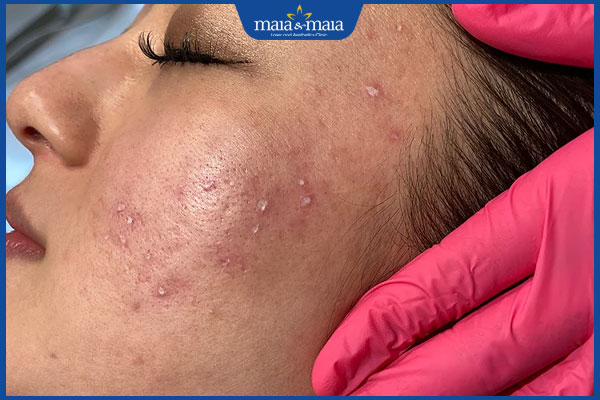 xóa tàn nhang gò má