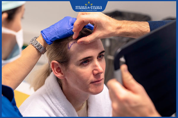 Chi phí phẫu thuật hạ đường chân tóc giá bao nhiêu tiền? 2 yếu tố ảnh hưởng đến chi phí hạ đường chân tóc