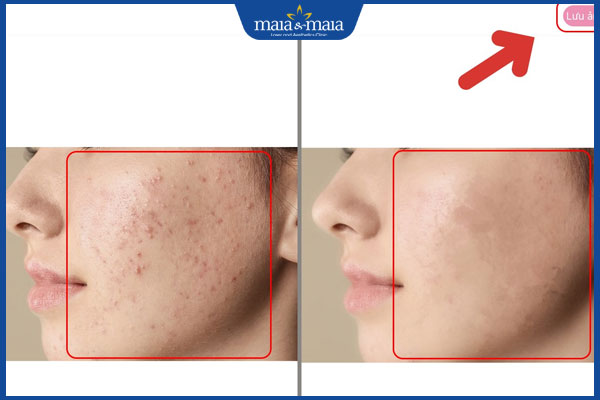 10 app xóa mụn miễn phí chỉnh sửa ảnh siêu hiệu quả hiện nay 3 app xóa mụn hypic