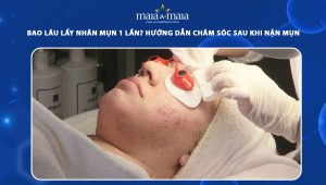 bao lâu lấy nhân mụn 1 lần