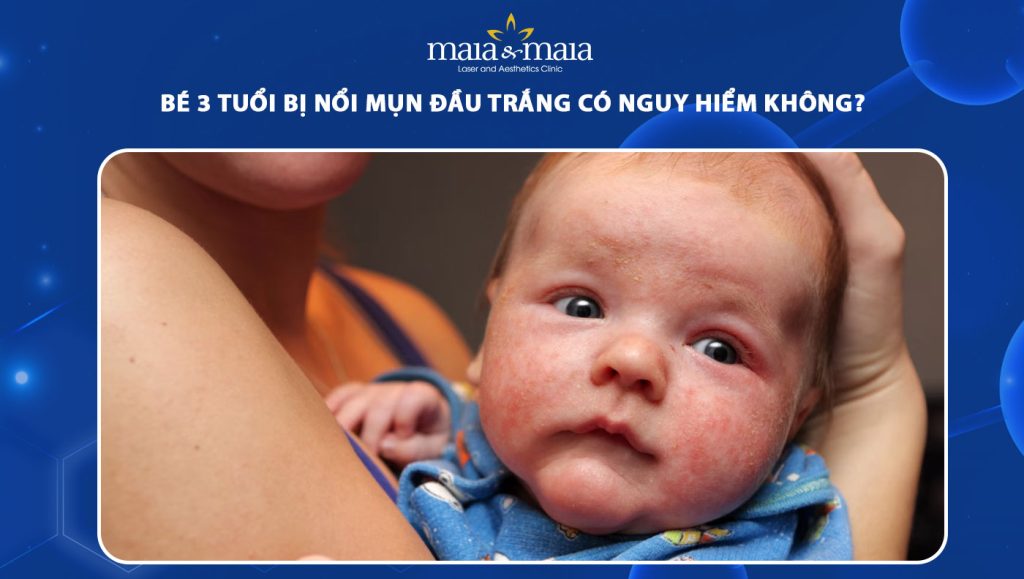 Bé 3 tuổi bị nổi mụn đầu trắng có nguy hiểm không? 1 bé 3 tuổi bị nổi mụn đầu trắng