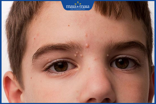 Bé 3 tuổi bị nổi mụn đầu trắng có nguy hiểm không? 2 bé 3 tuổi nổi mụn đầu trắng