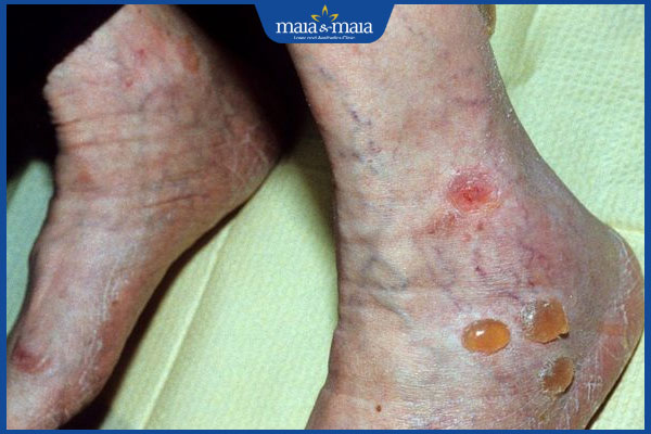 bệnh nhân bị tiểu đường