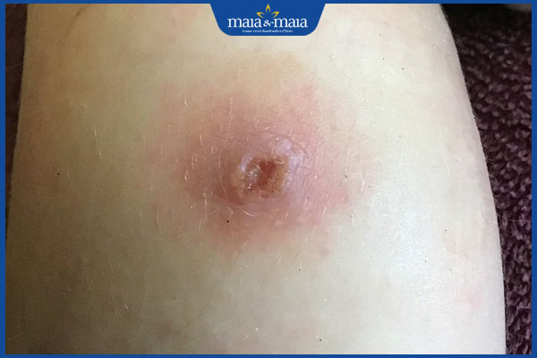 biến chứng mụn nhọt ở chân