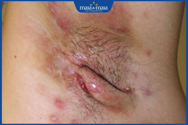 Nguyên nhân gây mụn ở nách và cách trị mụn hiệu quả nhất 3 biến chứng mụn ở nách