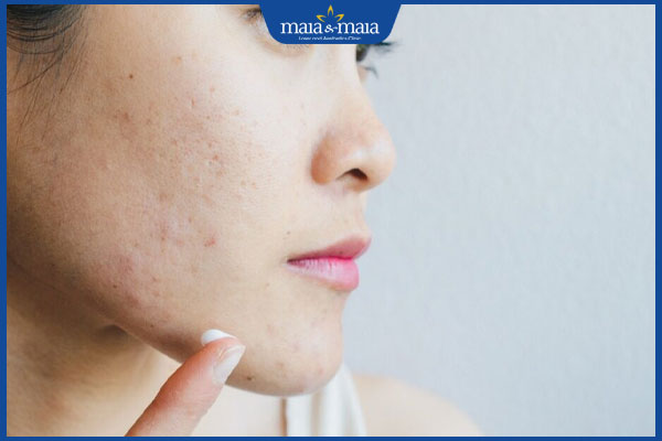 Mụn cám quanh miệng có tự hết không? Cách xóa mụn hiệu quả 4 bôi kem trị mụn cám ở cằm