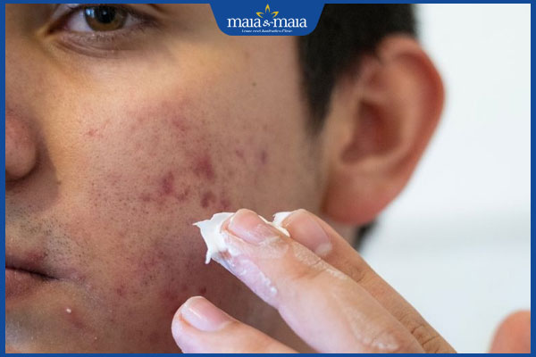 Mụn nhọt bị vỡ nguy hiểm không? Hướng dẫn xử lý đúng cách 4 bôi thuốc sau nặn mụn