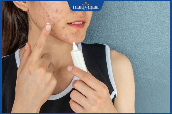 Mụn không nhân: Nhận biết, nguyên nhân và cách điều trị 4 bôi thuốc trị mụn ở quai hàm